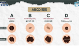 ‘점’이랑 헷갈리는 피부암, ‘ABCD’ 기억하세요