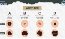 ‘점’이랑 헷갈리는 피부암, ‘ABCD’ 기억하세요
