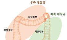 여성 대장암 절반 이상이 ‘오른쪽’…암 발생 경로부터 달랐다