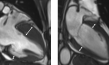 돌연사 키우는 조용한 병…'비후성 심근병증' 아세요?