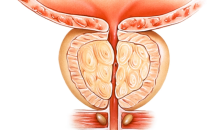 [의학 상식] 타이밍 놓친 전립선비대증 치료, 신장 건강 악화 불러올 수도