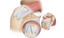 연세사랑병원, 광범위 파열 치료 위한 ‘ArthroFlex’ 이용 회전근개 재건술 도입